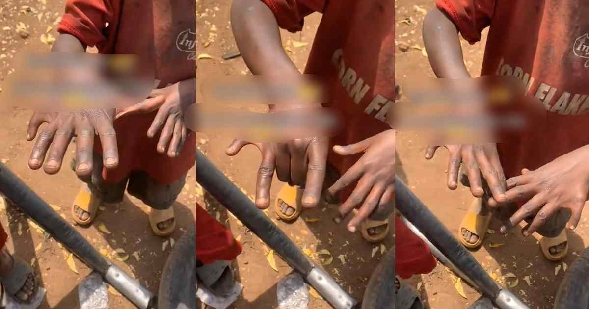 “Which one is the middle finger ?” – Man astonished to discover boy with six fingers (WATCH)