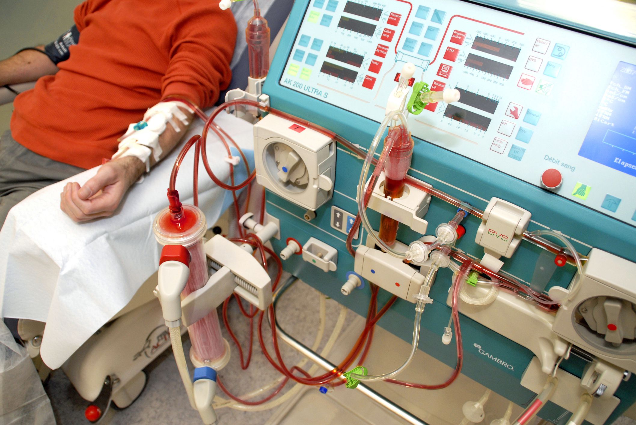 kidney dialysis