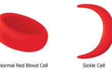 sickleCell