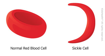 sickleCell